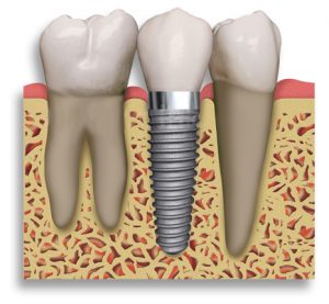 Dental implants look just like normal teeth.